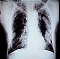 Las víctimas del asbesto del mundo entero reclaman el fin de «la impunidad»